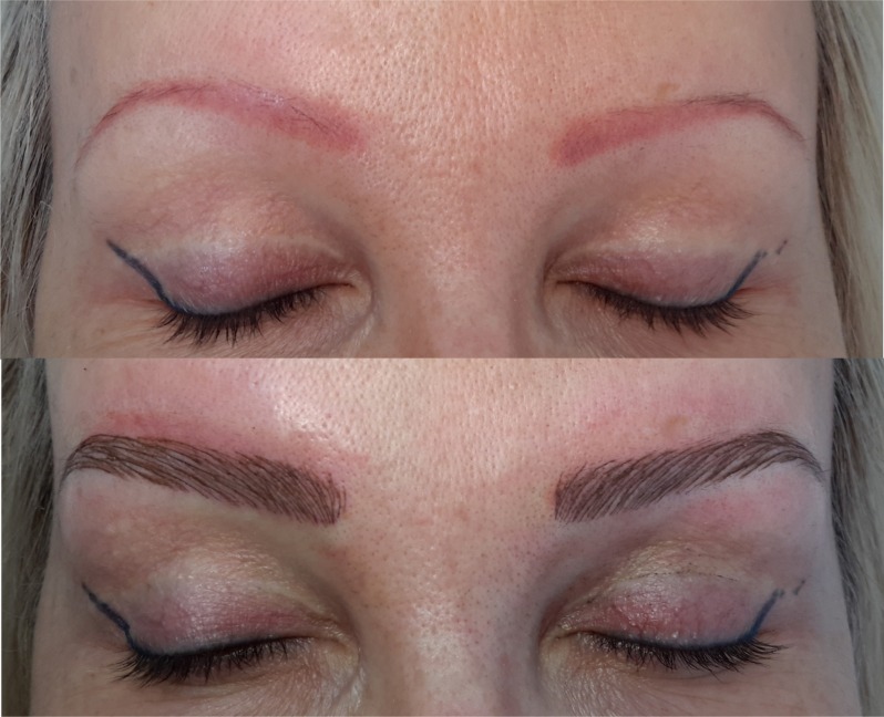 Permanent Makeup Correction What to Do About a Bad Eyebrow Tattoo