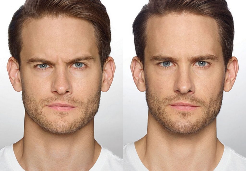 Anti Wrinkle Injections Brunswick Melbourne Non Surgical Face Lift
