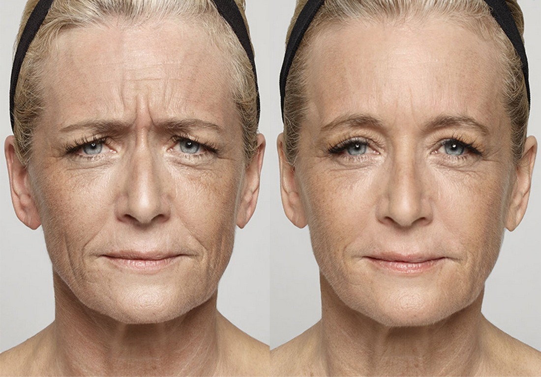 Wrinkling face. 3d моделирование фотоомоложение лица. Морщинки до после. Мужские и женщины морщины. Морщины женщина текстура.