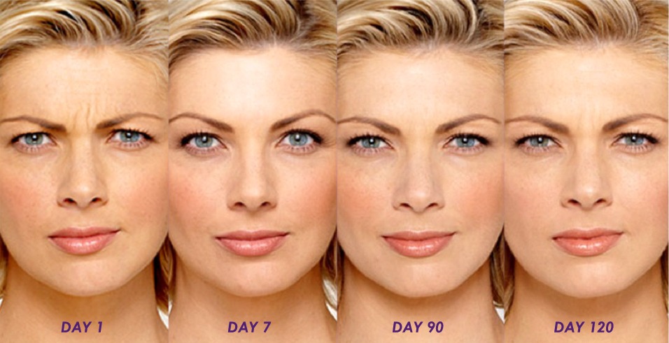 Anti Wrinkle Injections Brunswick Melbourne Non Surgical Face Lift