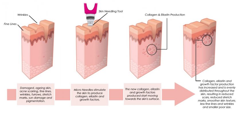 Skin Needling Skin Needling